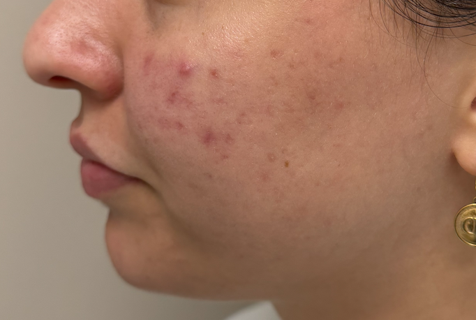 Laser Skin Rejuvenation Before