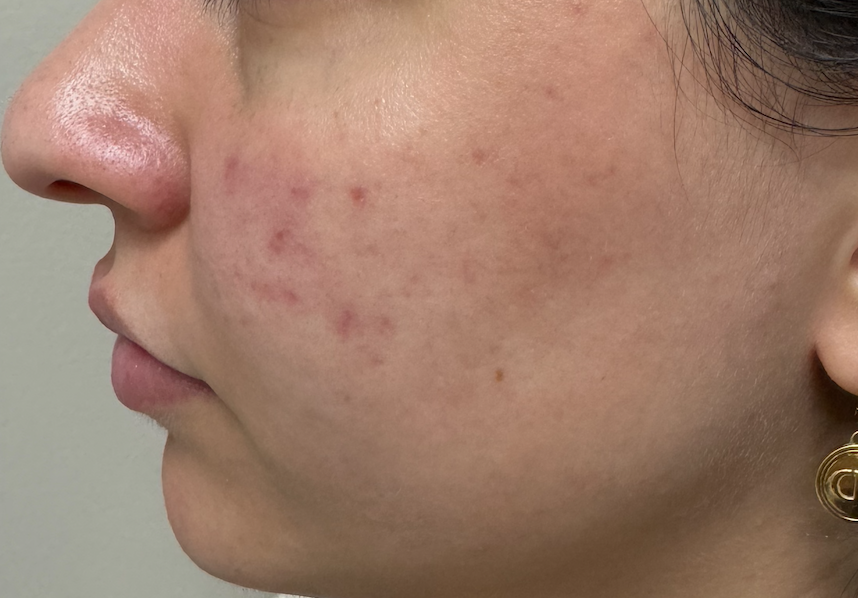 Laser Skin Rejuvenation After