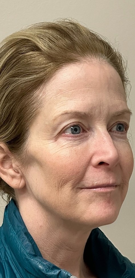 Laser Skin Rejuvenation Before & After