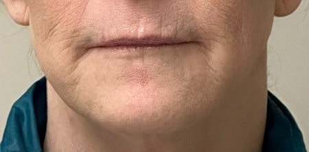 Laser Skin Rejuvenation Before & After