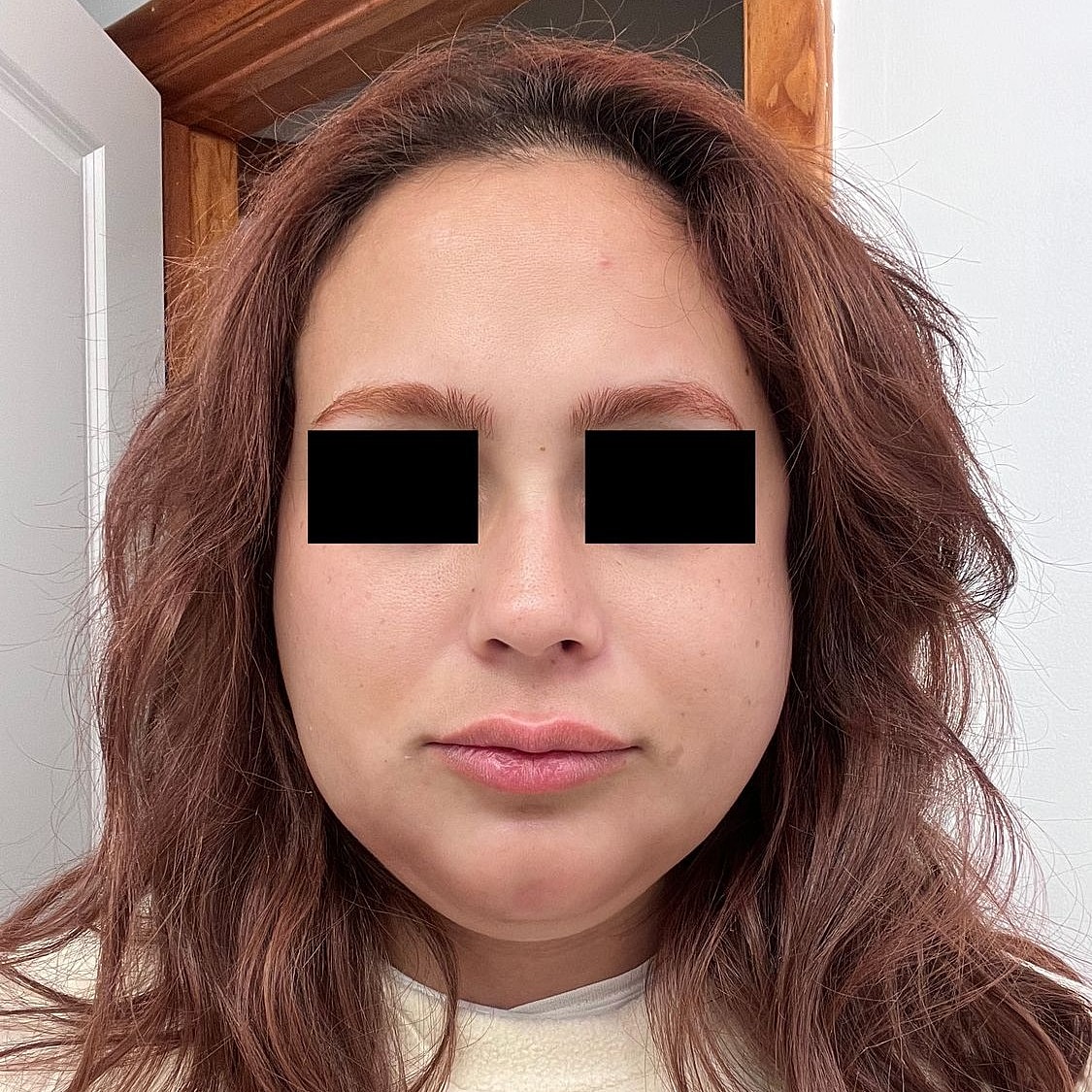 Ultrasound Guided Dissolve Before