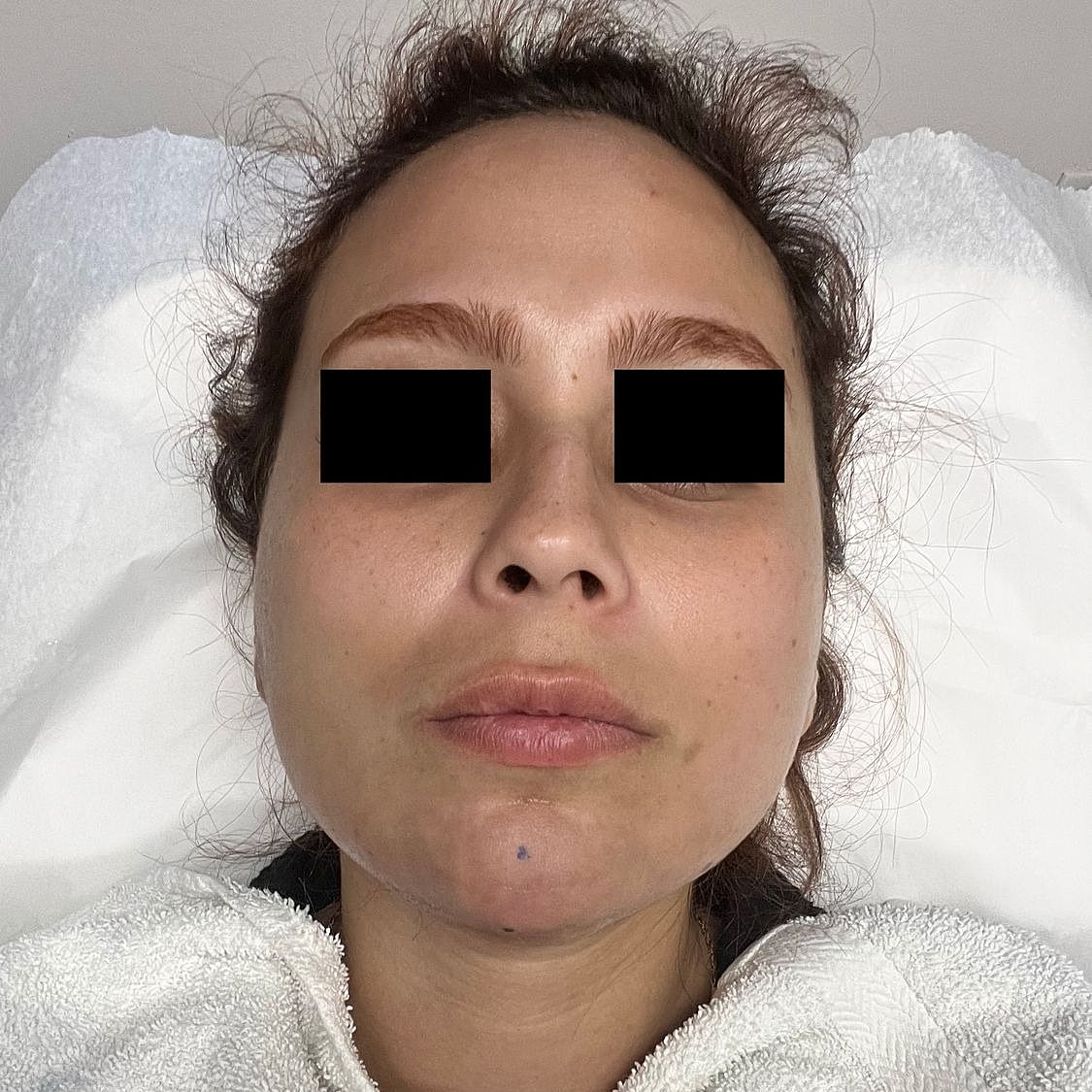 Ultrasound Guided Dissolve After