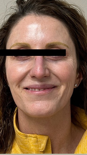 Ultrasound Guided Filler Dissolve Gallery Before & After