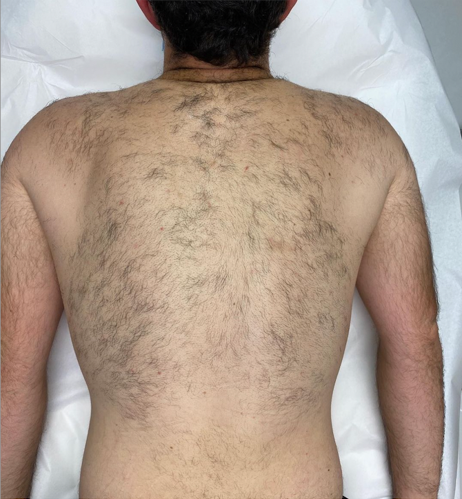 Laser Hair Removal After