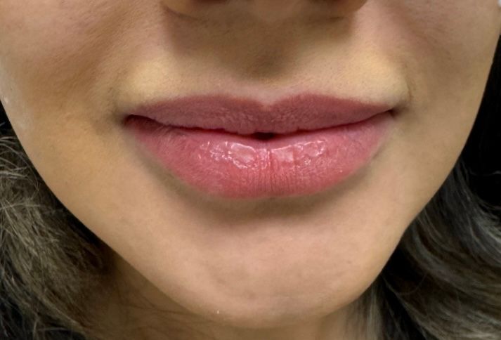 Dermal Fillers Gallery Before & After