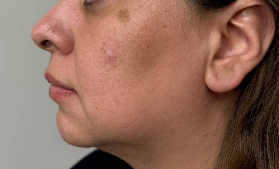 Dermal Fillers Gallery Before & After