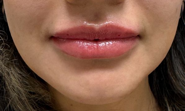 Dermal Fillers Gallery Before & After