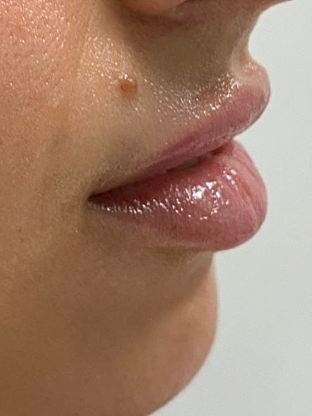 Dermal Fillers Gallery Before & After