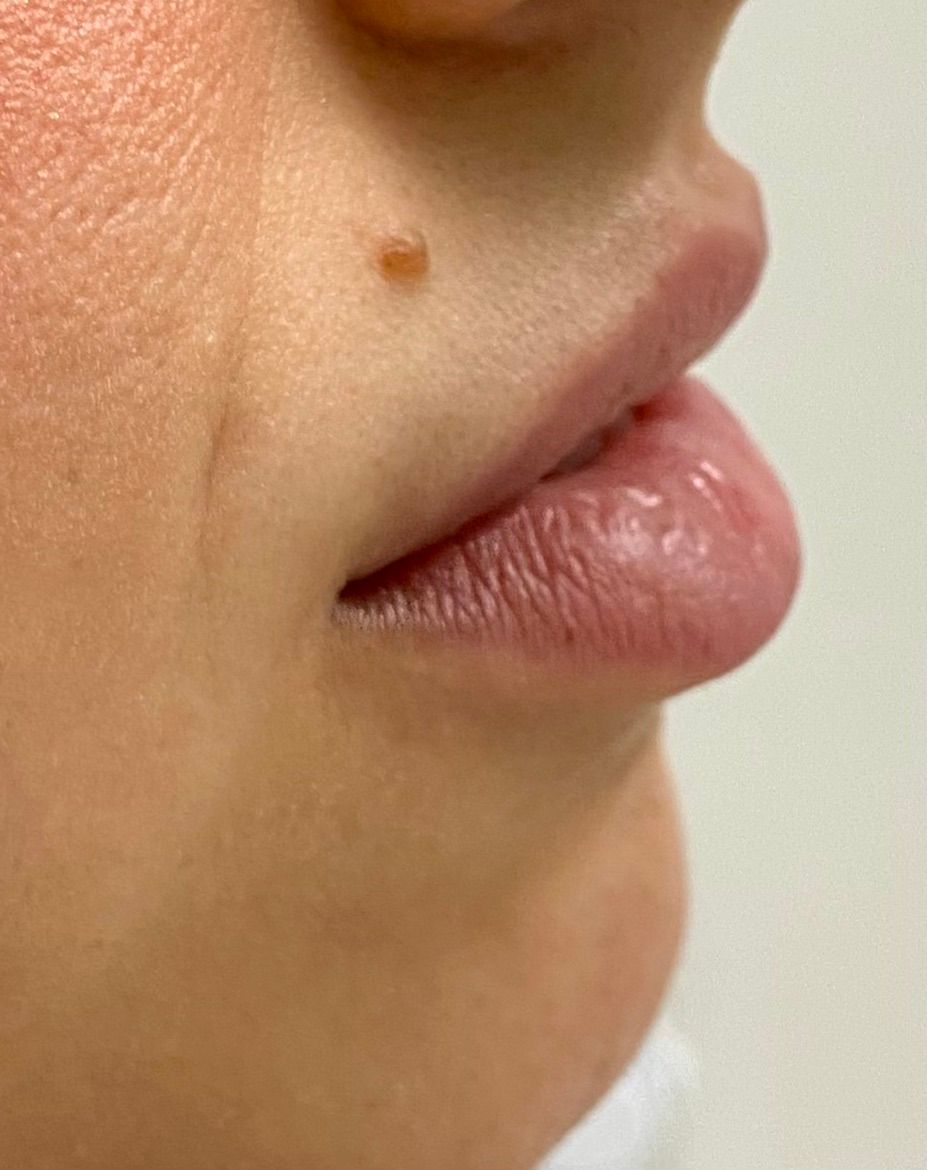 Dermal Fillers Gallery Before & After