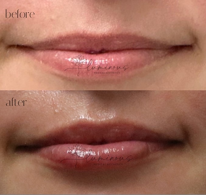 Dermal Fillers Gallery Before & After