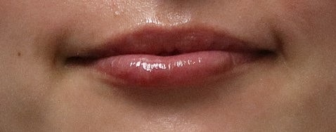 Dermal Fillers Gallery Before & After