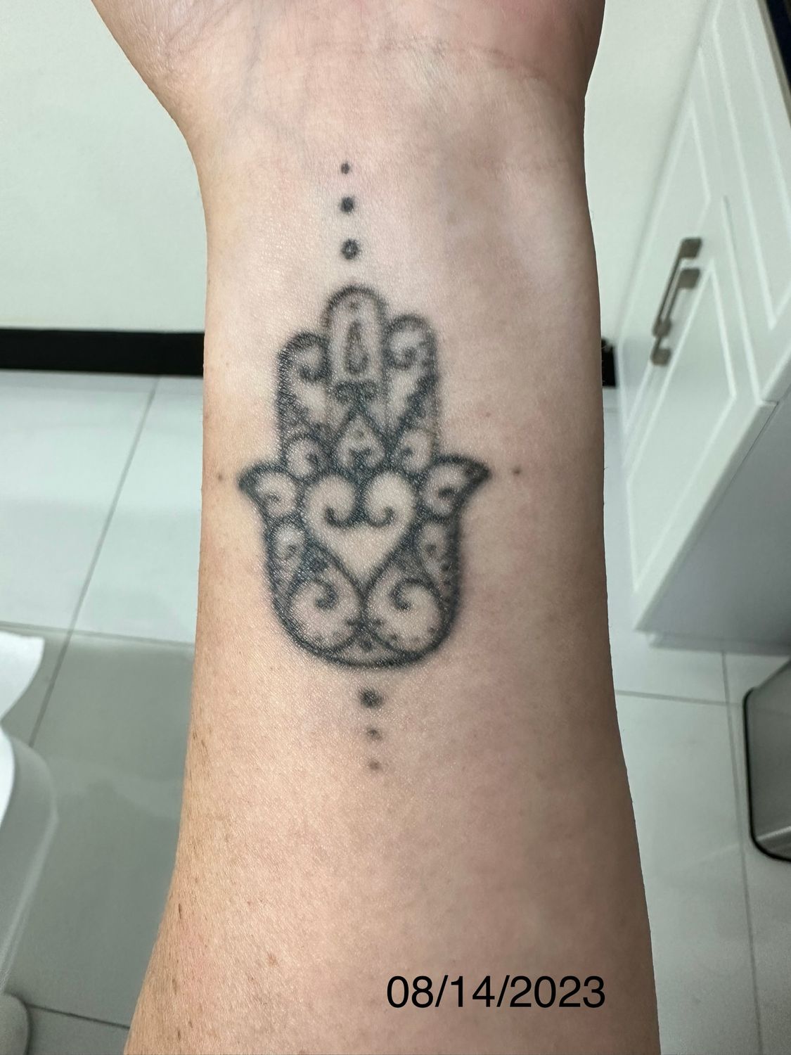 Tattoo Removal Gallery Before