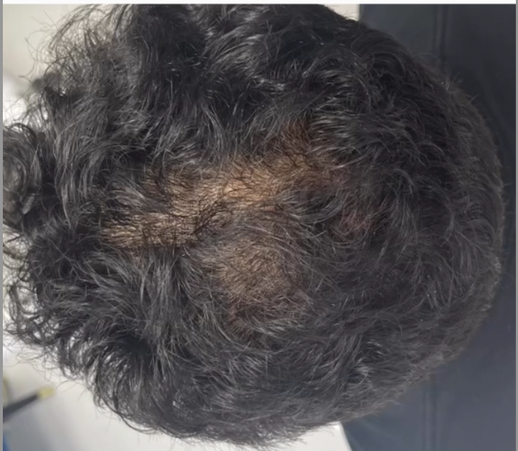 PRP Hair Restoration After