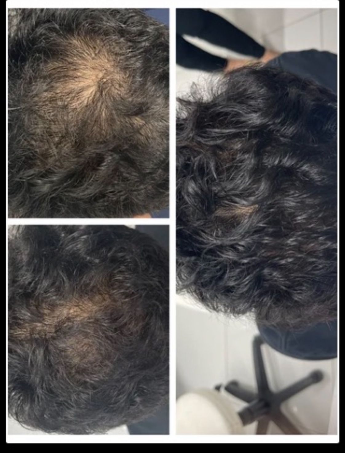 PRP Hair Restoration Before & After