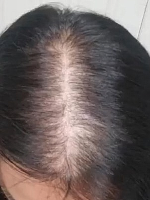 PRP Hair Restoration Before