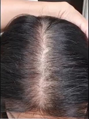 PRP Hair Restoration After