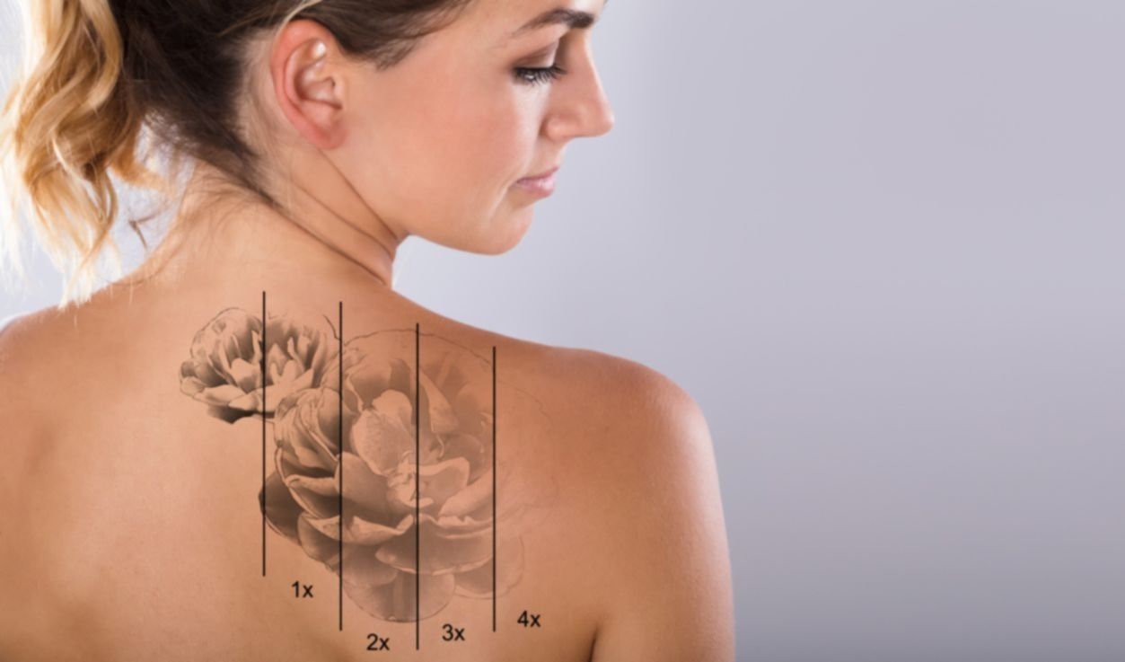 woodland hills tattoo removal model smiling